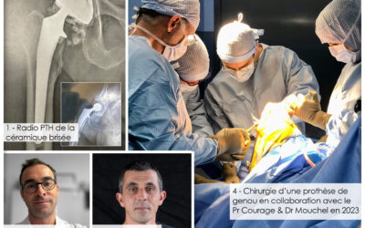 [⚕️ Chirurgie orthopédique – Une belle collaboration au service du patient sur un cas rare de reprise de Prothèse Totale de Hanche (PTH) sur bris céramique ]